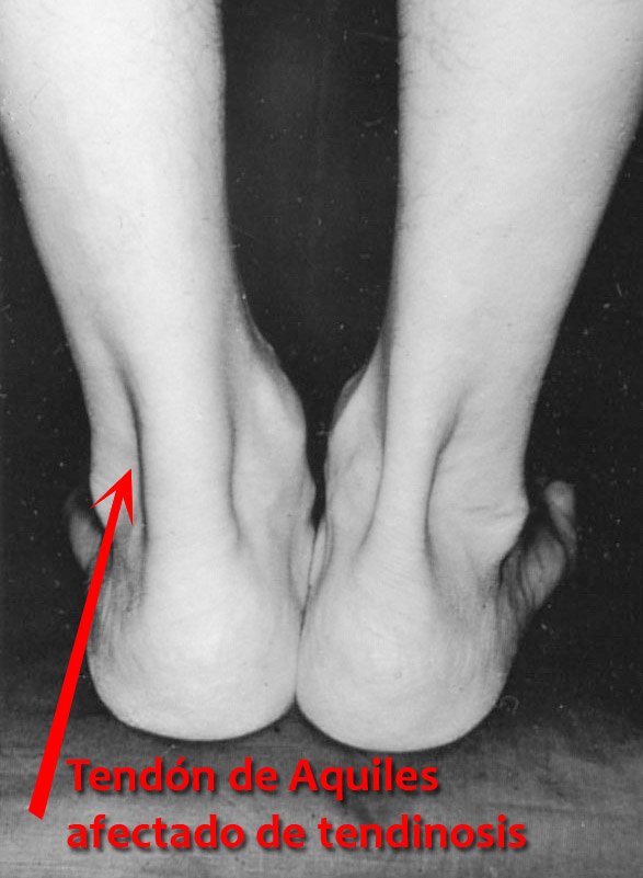tendinosis.jpg